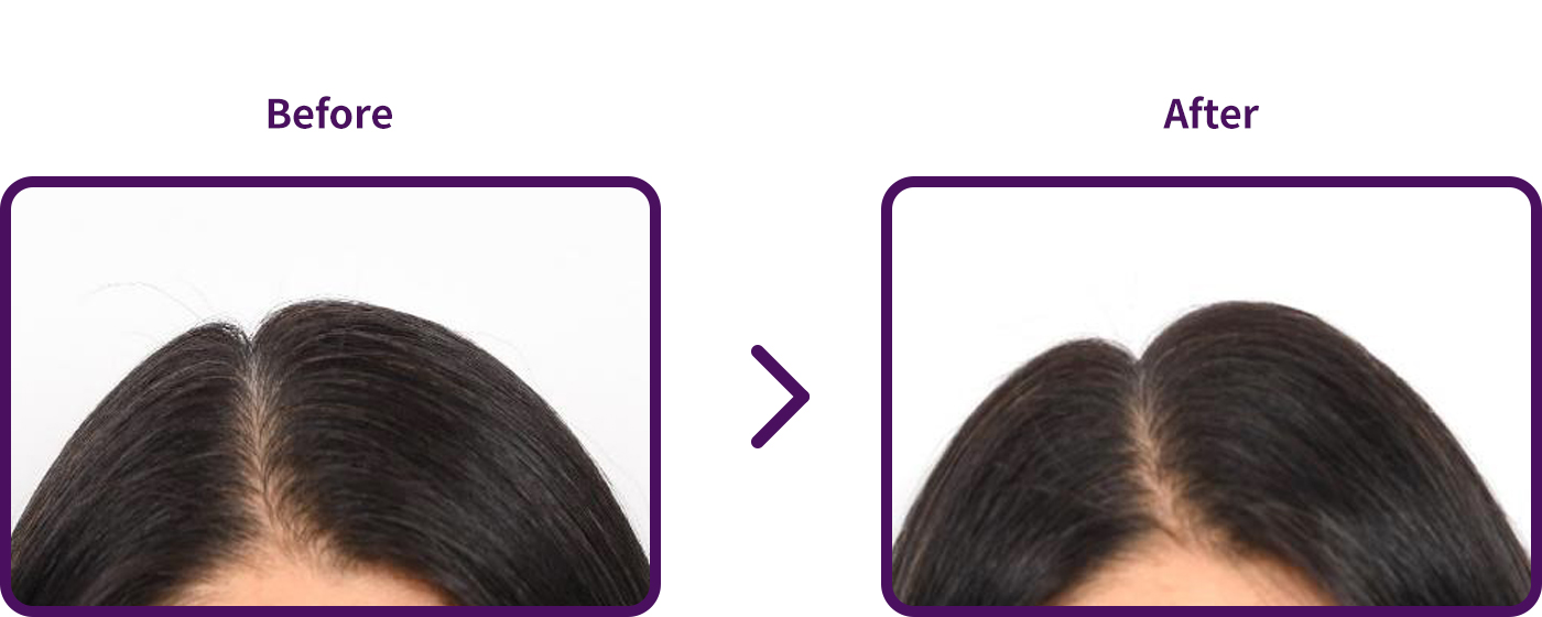 모발 볼륨 평가 비포애프터 이미지
